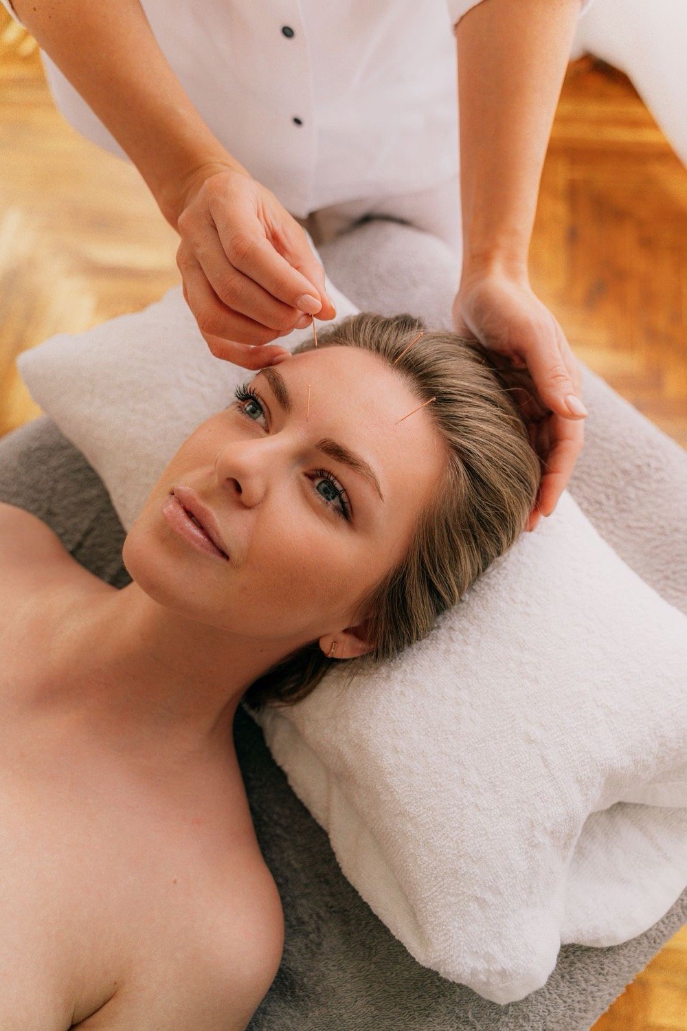 Acupuncture